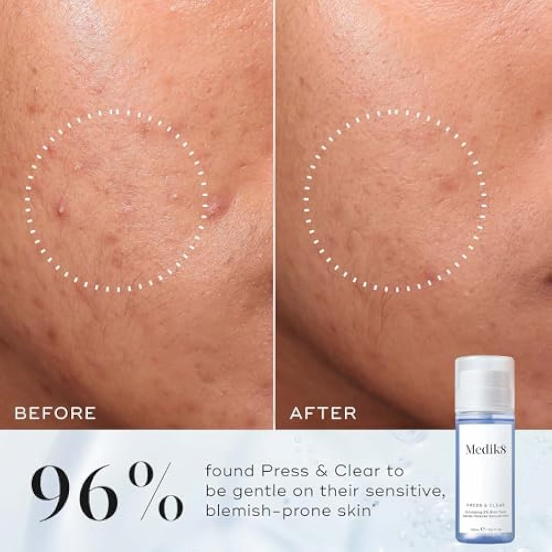 Medik8 Press & Clear Refill - Exfoliating 2% BHA Clarifying Toner - Salicylic & Tranexamic Acid - Reduces Blemishes, Blackheads & Oiliness - 150ml
