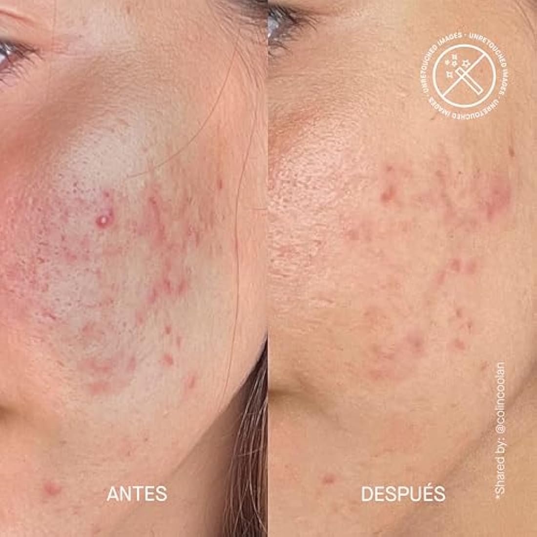 THERAMID AZID - 15% Azelaic Acid Treatment